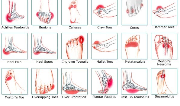 Foot Pain Chart Diagnosis